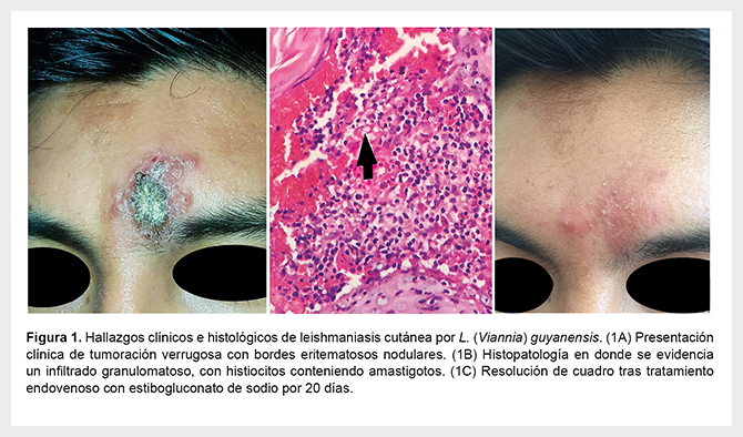 Leishmaniosis cutánea verrucosa inusual presentación